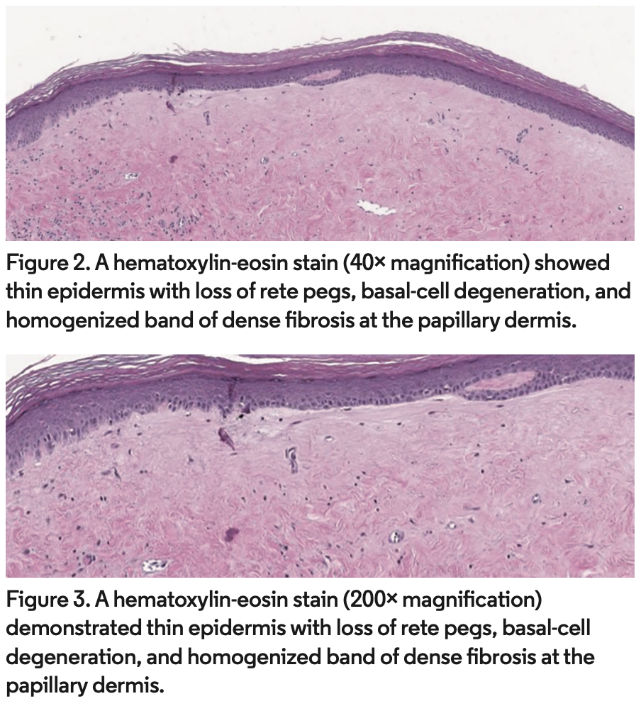 Lichen Sclerosis Histology